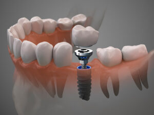 Cirurgia oral
