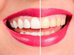 clareamento dental