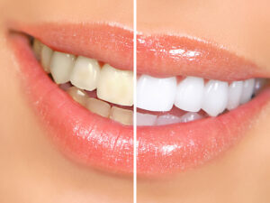 clareamento dental