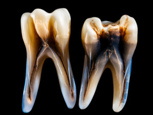 dentes com muitas cáries
