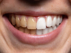 dentes amarelados