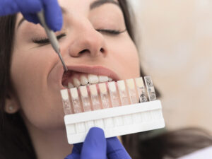 facetas dentárias
