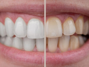 facetas dentárias
