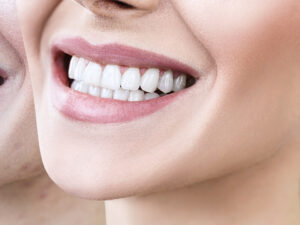 facetas dentárias
