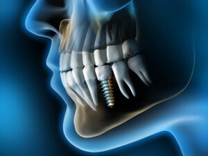 implantes dentários