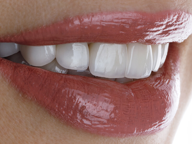 lentes de contato dental