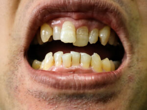 dentes tortos e amarelados